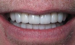 8-upper-and-8-lower-porcelain-veneers-After-Image