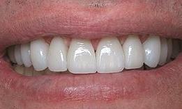 8-upper-porcelain-veneers-After-Image