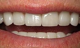 8-upper-porcelain-crowns-and-8-lower-porcelain-veneers-After-Image