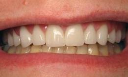 Porcelain-Crowns-and-bleaching-After-Image