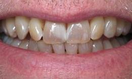8-upper-and-8-lower-porcelain-veneers-Before-Image