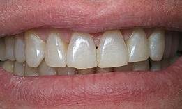 8-upper-porcelain-veneers-Before-Image