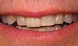 8-upper-porcelain-crowns-and-8-lower-porcelain-veneers-Before-Image