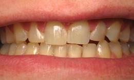 Porcelain-Crowns-and-bleaching-Before-Image