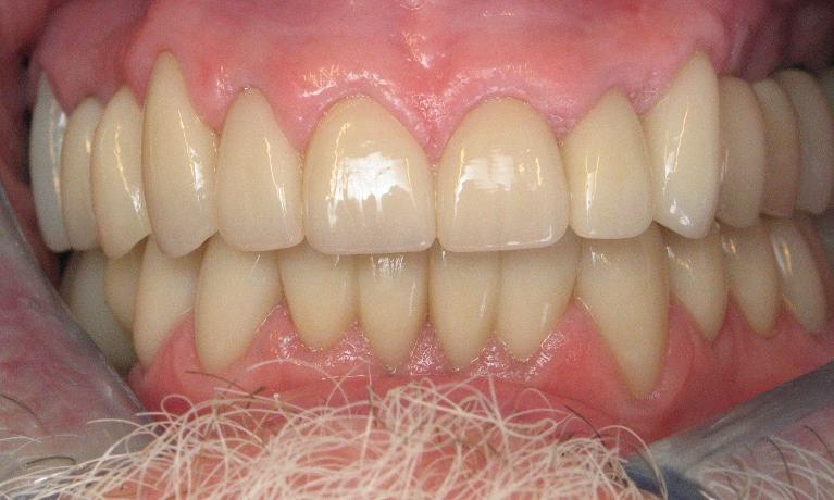 Full-Mouth-Restoration-After-Image