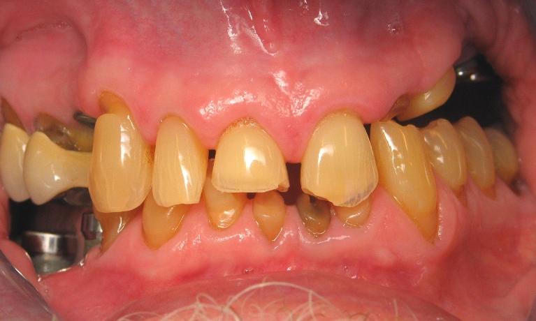 Full-Mouth-Restoration-Before-Image